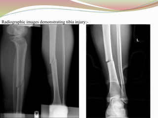 Radiographic images demonstrating tibia injury:-
 