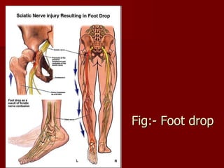 Drop Injury dislocation and subluxation 3.ppt