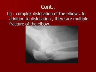 Complex Dislocation dislocation and subluxation 3.ppt