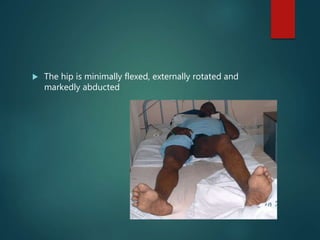  The hip is minimally flexed, externally rotated and
markedly abducted
 