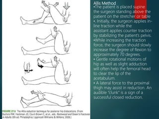 Allis Method
•The patient is placed supine
the surgeon standing above the
patient on the stretcher or table
•. Initially, the surgeon applies in-
line traction while the
assistant applies counter traction
by stabilizing the patient’s pelvis.
•While increasing the traction
force, the surgeon should slowly
increase the degree of flexion to
approximately 70 degrees.
• Gentle rotational motions of
hip as well as slight adduction
will often help the femoral head
to clear the lip of the
acetabulum.
• A lateral force to the proximal
thigh may assist in reduction. An
audible “clunk” is a sign of a
successful closed reduction.
 