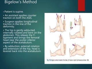 Bigelow’s Method
• Patient is supine.
• An assistant applies counter
traction on both the ASIS.
• Surgeon applies longitudinal
traction in the line of the
deformity.
• The hip is gently adducted,
internally rotated and bent on the
abdomen. This relaxes the Y-
ligament and brings the femoral
head near the poster inferior
aspect of the acetabulum.
• By adduction, external rotation
and extension of the hip, head is
levered back into the acetabulum.
 