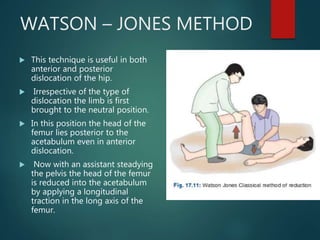WATSON – JONES METHOD
 This technique is useful in both
anterior and posterior
dislocation of the hip.
 Irrespective of the type of
dislocation the limb is first
brought to the neutral position.
 In this position the head of the
femur lies posterior to the
acetabulum even in anterior
dislocation.
 Now with an assistant steadying
the pelvis the head of the femur
is reduced into the acetabulum
by applying a longitudinal
traction in the long axis of the
femur.
 