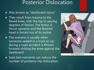 Posterior Dislocation
 Also known as “dashboard injury”
 They result from trauma to the
flexed knee, with the hip in varying
degrees of flexion. The femur is
thrust upwards and the femoral
head is forced out of its socket.
 The scenario is usually when
someone seated in a truck or car,
during a road accident is thrown
forward striking the knee against the
dashboard.
 Seat-belt restraints can reduce the
number of posterior hip dislocation.
 