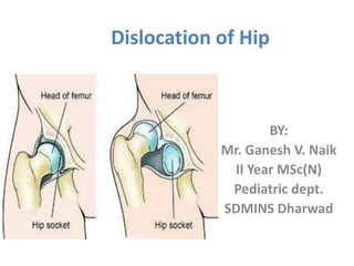 Dislocation of Hip
BY:
Mr. Ganesh V. Naik
II Year MSc(N)
Pediatric dept.
SDMINS Dharwad
 