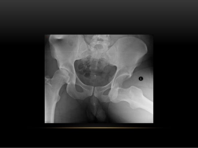 Dislocation of hip joint