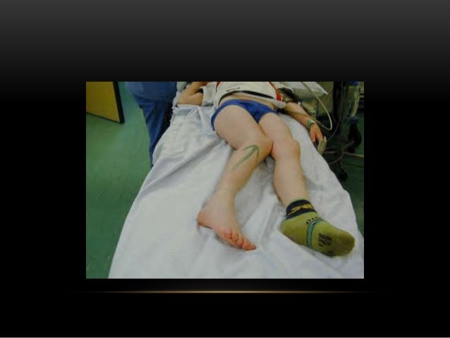 Dislocation of hip joint