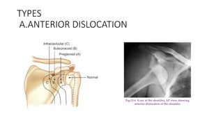 DISLOCATION OF MAJOR JOINT DKJFBSDKJF.pptx