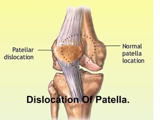 Dislocation Of Patella. 