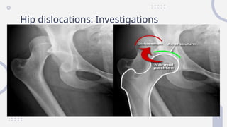 DISLOCATIONS, subluxation and management.pptx