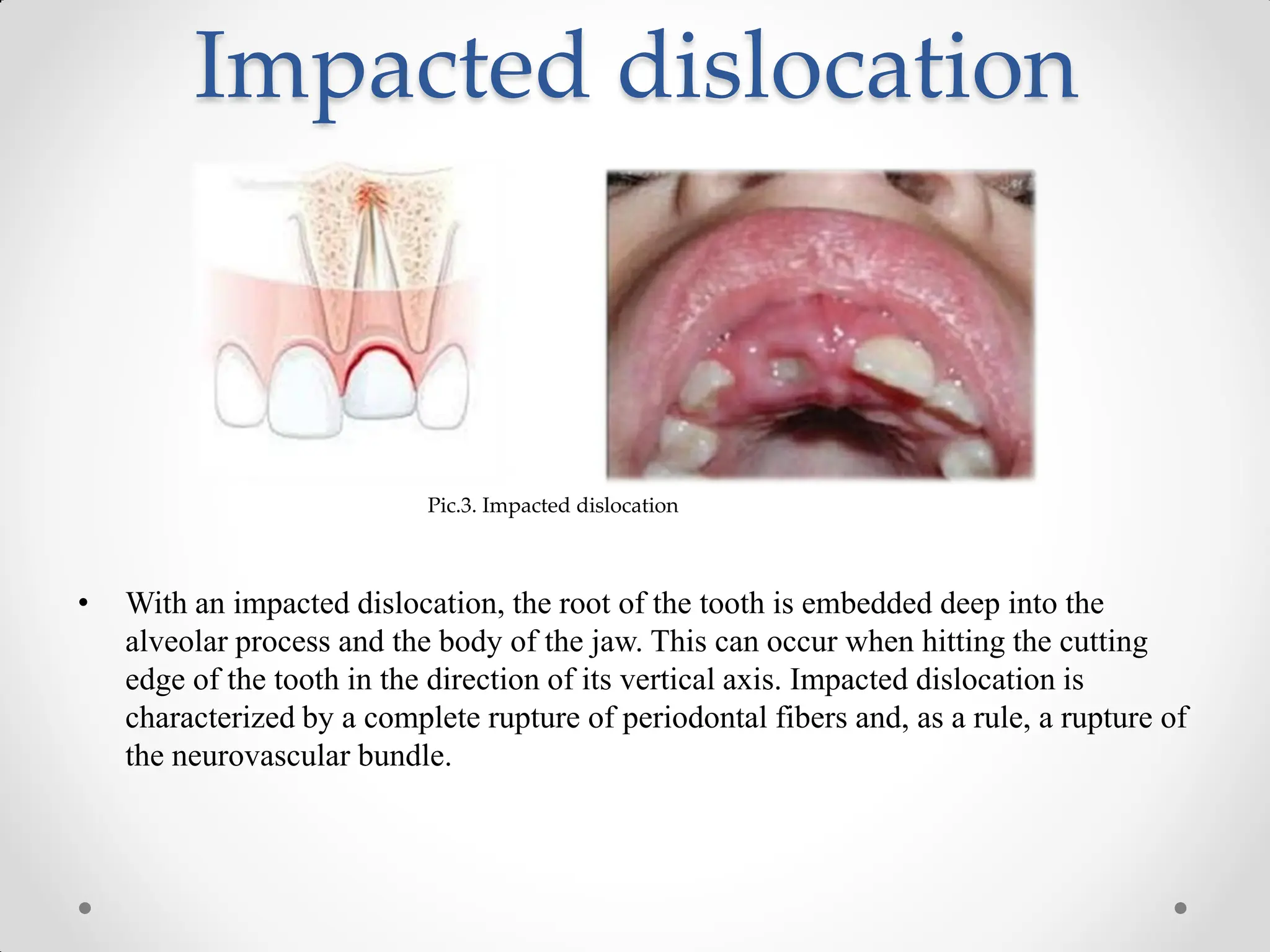 Tooth Rupture dislocations and fractures of the teeth.pdf