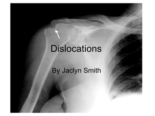 Dislocations | PPT