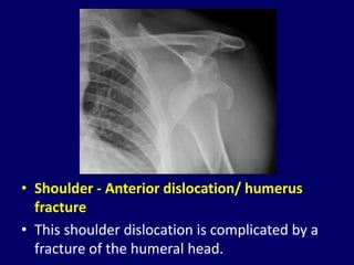 Humurus Dislocation Dislocations of joint. Joint Dislocation | PPTX