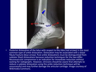 Talus Dislocation Dislocations of joint. Joint Dislocation | PPTX