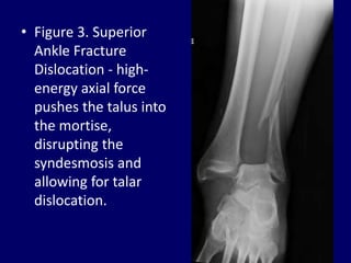 Dislocations of joint. Joint Dislocation | PPTX