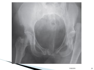 Dislocations of Lower limb orthopedic ppt | PPT