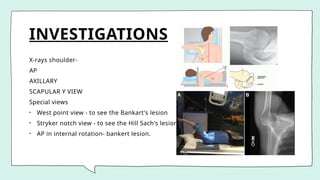 INVESTIGATIONS
X-rays shoulder-
AP
AXILLARY
SCAPULAR Y VIEW
Special views
• West point view - to see the Bankart's lesion
• Stryker notch view - to see the Hill Sach's lesion
• AP in internal rotation- bankert lesion.
 