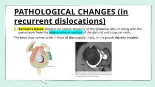 PATHOLOGICAL CHANGES (in
recurrent dislocations)
1. Bankart's lesion: Dislocation causes stripping of the glenoidal labrum along with the
periosteum from the antero-inferior surface of the glenoid and scapular neck.
The head thus comes to lie in front of the scapular neck, in the pouch thereby created.
 