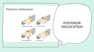 POSTERIOR
DISLOCATION
 