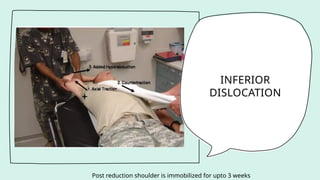 INFERIOR
DISLOCATION
Post reduction shoulder is immobilized for upto 3 weeks
 
