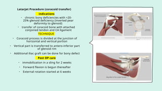 Latarjet Procedure (coracoid transfer)
indications
• chronic bony deficiencies with >20-
25% glenoid deficiency (inverted pear
deformity to glenoid)
• transfer of coracoid bone with attached
conjoined tendon and CA ligament
TECHNIQUE
• Coracoid process is divided at the junction of
horizontal and vertical portion
• Vertical part is transferred to antero-inferior part
of glenoid rim
• Additional iliac graft can be done for bony defect
Post OP care
• immobilization in a sling for 2 weeks
• Forward flexion is begun thereafter
• External rotation started at 6 weeks
 