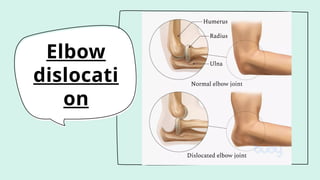 Elbow
dislocati
on
 