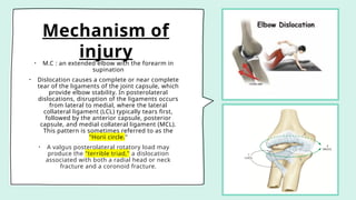 Mechanism of
injury
• M.C : an extended elbow with the forearm in
supination
• Dislocation causes a complete or near complete
tear of the ligaments of the joint capsule, which
provide elbow stability. In posterolateral
dislocations, disruption of the ligaments occurs
from lateral to medial, where the lateral
collateral ligament (LCL) typically tears first,
followed by the anterior capsule, posterior
capsule, and medial collateral ligament (MCL).
This pattern is sometimes referred to as the
"Horii circle."
• A valgus posterolateral rotatory load may
produce the "terrible triad," a dislocation
associated with both a radial head or neck
fracture and a coronoid fracture.
 