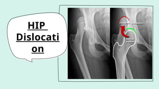 HIP
Dislocati
on
 