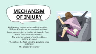 MECHANISM
OF INJURY
High-energy trauma: motor vehicle accident,
fall from a height, or an industrial accident.
Force transmission to the hip joint results from
one of three common sources:
• The anterior surface of the flexed knee
striking an object
• The sole of the foot, with the ipsilateral knee
extended
• The greater trochanter
 