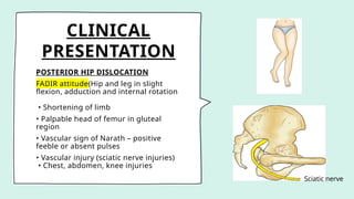 CLINICAL
PRESENTATION
POSTERIOR HIP DISLOCATION
FADIR attitude(Hip and leg in slight
flexion, adduction and internal rotation
• Shortening of limb
• Palpable head of femur in gluteal
region
• Vascular sign of Narath – positive
feeble or absent pulses
• Vascular injury (sciatic nerve injuries)
• Chest, abdomen, knee injuries
Sciatic nerve
 