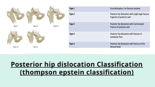 Posterior hip dislocation Classification
(thompson epstein classification)
 