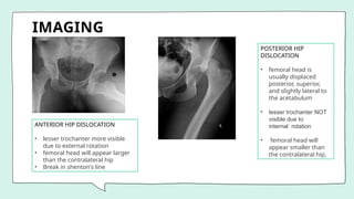 IMAGING
ANTERIOR HIP DISLOCATION
• lesser trochanter more visible
due to external rotation
• femoral head will appear larger
than the contralateral hip
• Break in shenton's line
POSTERIOR HIP
DISLOCATION
• femoral head is
usually displaced
posterior, superior,
and slightly lateral to
the acetabulum
• lesser trochanter NOT
visible due to
internal rotation
• femoral head will
appear smaller than
the contralateral hip,
 
