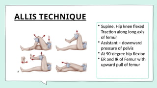 ALLIS TECHNIQUE
• Supine, Hip knee flexed
Traction along long axis
of femur
• Assistant – downward
pressure of pelvis
• At 90-degree hip flexion
• ER and IR of Femur with
upward pull of femur
 