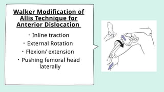 Walker Modification of
Allis Technique for
Anterior Dislocation
• Inline traction
• External Rotation
• Flexion/ extension
• Pushing femoral head
laterally
 