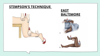 STIMPSON'S TECHNIQUE
EAST
BALTIMORE
LIFT
TECHNIQUE
 
