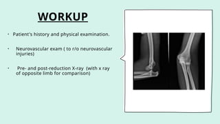 WORKUP
• Patient's history and physical examination.
• Neurovascular exam ( to r/o neurovascular
injuries)
• Pre- and post-reduction X-ray (with x ray
of opposite limb for comparison)
 