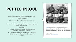 PGI TECHNIQUE
Most atraumatic way of reducing the hip joint
• Single surgeon
• Maneuvers after sedation and anesthesia :
1a, 1b – limb is completely flexed until upper part of
thigh touches the
abdomen
1c – once complete flexion is achieved limb is
abducted as much as possible
1d – once full abduction is achieved – external
rotation is done – Click is heard and joint is
reduced
 