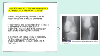 • limb threatening- orthopaedic emergency
(POTENTIAL FOR VASCULAR DAMAGE)
•Result of high-energy injuries, such as
motor vehicle or industrial accidents.
•The dynamic and static stability of the knee
is conferred mainly by soft tissues
(ligaments, muscles, tendons, menisci) in
addition to the bony articulations.
•Significant soft tissue injury is necessary
for knee dislocation. (rupture of
cruciate,collateral, capsular elements &
menisci.
 