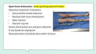 Open knee dislocation : knee spanning external fixator
Operative treatment: Indications
• Unsuccessful closed reduction
• Residual soft issue interposition
• Open injuries
• Vascular injuries
Assess distal pulses pre and post reduction
If any doubt do angiogram
Revasularization should be done within 8 hours
 