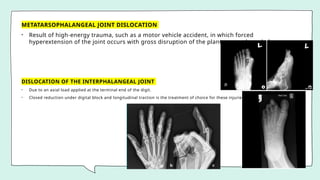 METATARSOPHALANGEAL JOINT DISLOCATION
• Result of high-energy trauma, such as a motor vehicle accident, in which forced
hyperextension of the joint occurs with gross disruption of the plantar capsule and plate.
DISLOCATION OF THE INTERPHALANGEAL JOINT
• Due to an axial load applied at the terminal end of the digit.
• Closed reduction under digital block and longitudinal traction is the treatment of choice for these injuries.
 