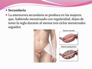  Secundaria
 La amenorrea secundaria se produce en las mujeres
que, habiendo menstruado con regularidad, dejan de
tener la regla durante al menos tres ciclos menstruales
seguidos
 