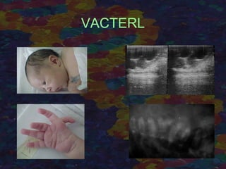 VACTERL
 