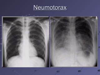 Neumotorax
 
