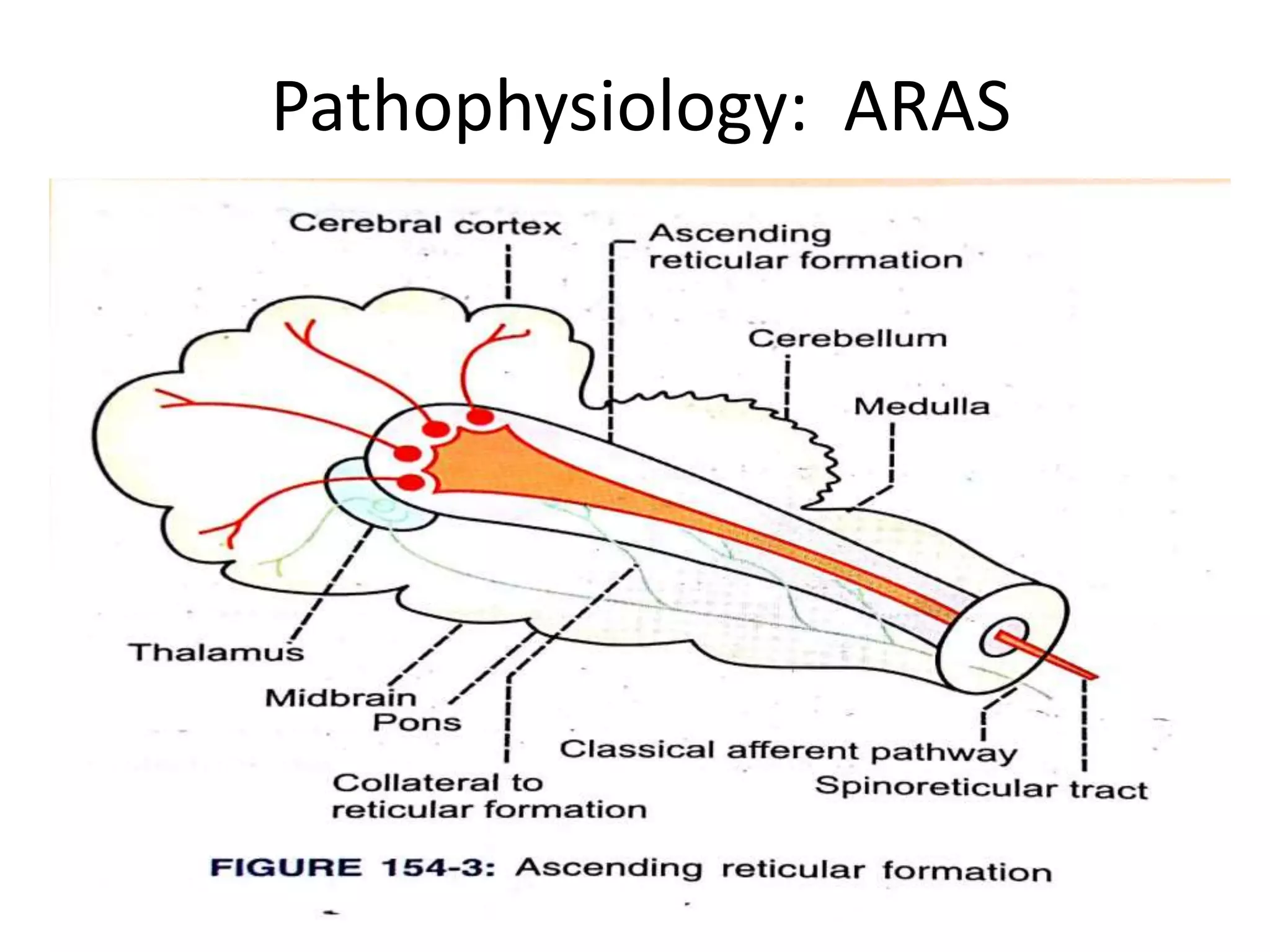 Pathophysiology: ARAS
 