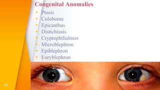 Congenital Anomalies
▸ Ptosis
▸ Coloboma
▸ Epicanthus
▸ Distichiasis
▸ Cryptophthalmos
▸ Microblephron
▸ Epiblephron
▸ Euryblephron
11
 