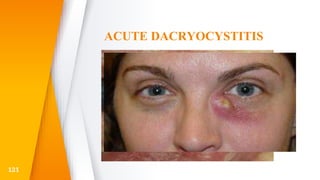ACUTE DACRYOCYSTITIS
121
 
