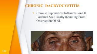 CHRONIC DACRYOCYSTITIS
▸ Chronic Suppurative Inflammation Of
Lacrimal Sac Usually Resulting From
Obstruction Of NL
126
 
