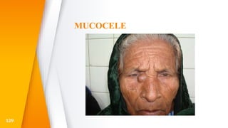 MUCOCELE
129
 