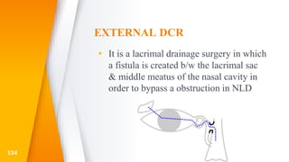 EXTERNAL DCR
▸ It is a lacrimal drainage surgery in which
a fistula is created b/w the lacrimal sac
& middle meatus of the nasal cavity in
order to bypass a obstruction in NLD
134
 