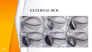 EXTERNAL DCR
135
 
